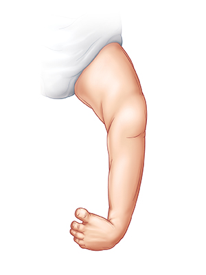 Contorno de la pierna de un bebe que mestra un pie zambo.