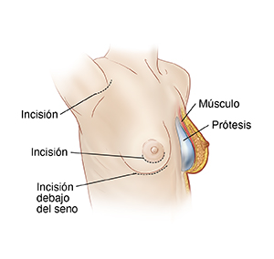 Vista de tres cuartos de un pecho femenino donde se observan las incisiones para un implante de mama a la derecha y un corte transversal de la mama izquierda donde se observa el implante colocado.