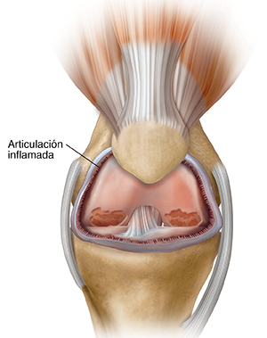 Vista frontal de una articulación de rodilla en donde puede verse inflamación y artritis.