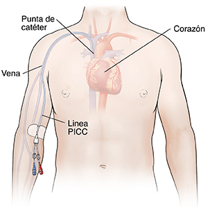 Bosquejo de una figura humana con un catéter insertado debajo del codo. Hay dos puertos al final del catéter. Puede verse el catéter en la vena dirigiéndose hacia el corazón.