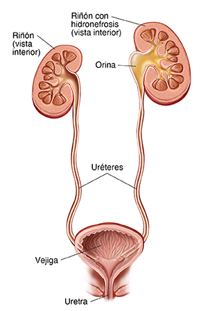 Vista frontal de un corte transversal de los riñones, los uréteres y la vejiga. El uréter izquierdo se obstruye cerca del riñón, y la orina se acumula en el riñón.