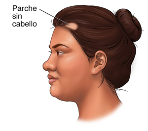 Vista lateral de la cabeza de una mujer en la que se ve un parche sin cabello.