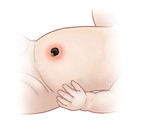 Primer plano de abdomen del bebé que muestra inflamación del vientre alrededor del muñón del cordón umbilical.