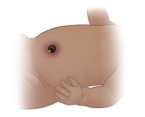 Primer plano de abdomen del bebé que muestra inflamación del vientre alrededor del muñón del cordón umbilical.