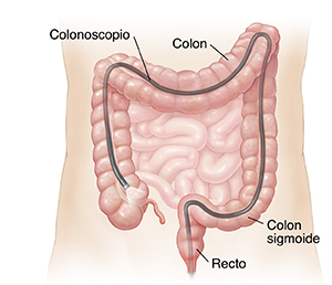 Contorno de un abdomen que muestra el colonoscopio insertado a través del ano en todo el colon.