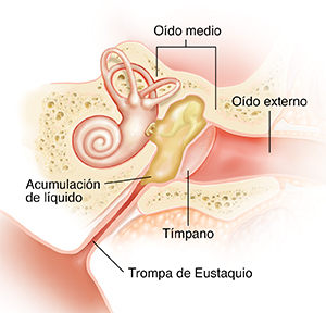 Corte transversal del oído de un niño donde puede verse líquido en el oído medio.