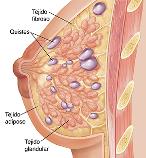 Corte transversal visto de lado de un seno que muestra tejido glandular, tejido fibroso y tejido graso. Se ven múltiples quistes en el tejido del seno.
