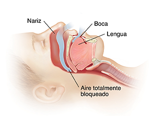 Corte transversal con vista lateral de la cabeza de una persona con apnea obstructiva del sueño.
