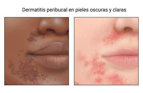 Dermatitis peribucal en un rostro de piel oscura y en otro de piel clara.