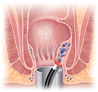 Corte transversal de ano que muestra el tratamiento de hemorroides con láser.