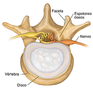 Vista superior de vértebra y disco lumbares donde pueden verse espolones óseos que presionan sobre el nervio espinal.
