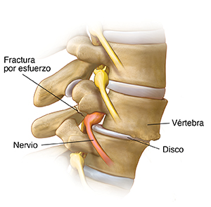 Vista lateral de las vértebras de la región lumbar donde se observa espondilolistesis y fractura por fatiga.