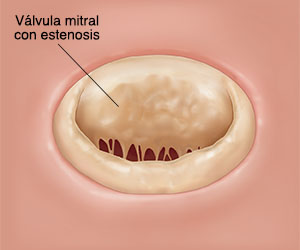 Vista superior de una válvula mitral abierta con estenosis.