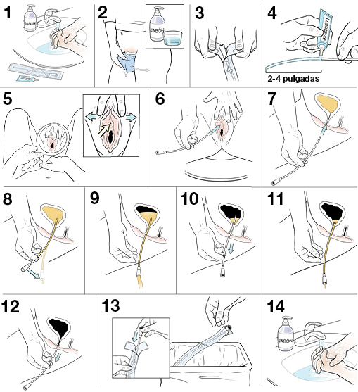 14 pasos para insertar un catéter urinario desechable.