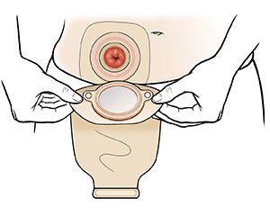 Manos colocando la bolsa de ileostomía sobre el estoma.