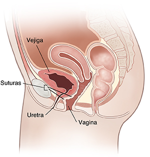 Vista lateral de corte transversal de la pelvis femenina, donde se observa la suspensión retropúbica.